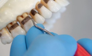 Effective instrumentation with Gracey Curettes - LM-Dental