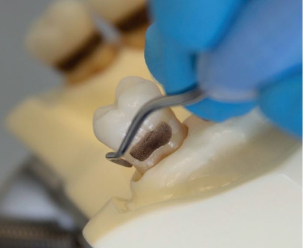 Effective instrumentation with Gracey Curettes - LM-Dental