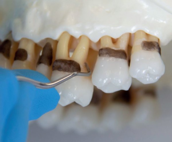 Effective instrumentation with Gracey Curettes - LM-Dental