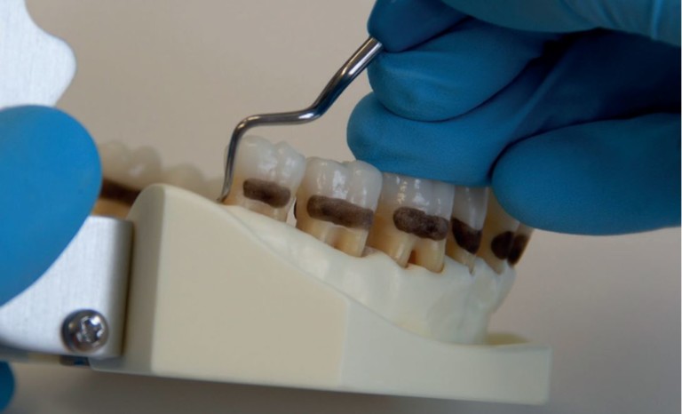 Effective instrumentation with Gracey Curettes - LM-Dental