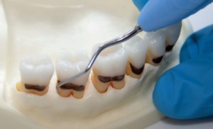 Effective instrumentation with Gracey Curettes - LM-Dental