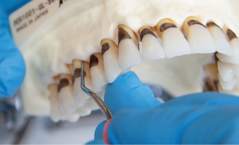 Effective instrumentation with Gracey Curettes - LM-Dental