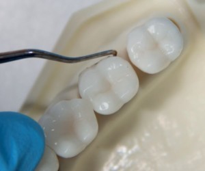 Langer Figure Effective instrumentation with LM™ Langer curettes - LM-Dental