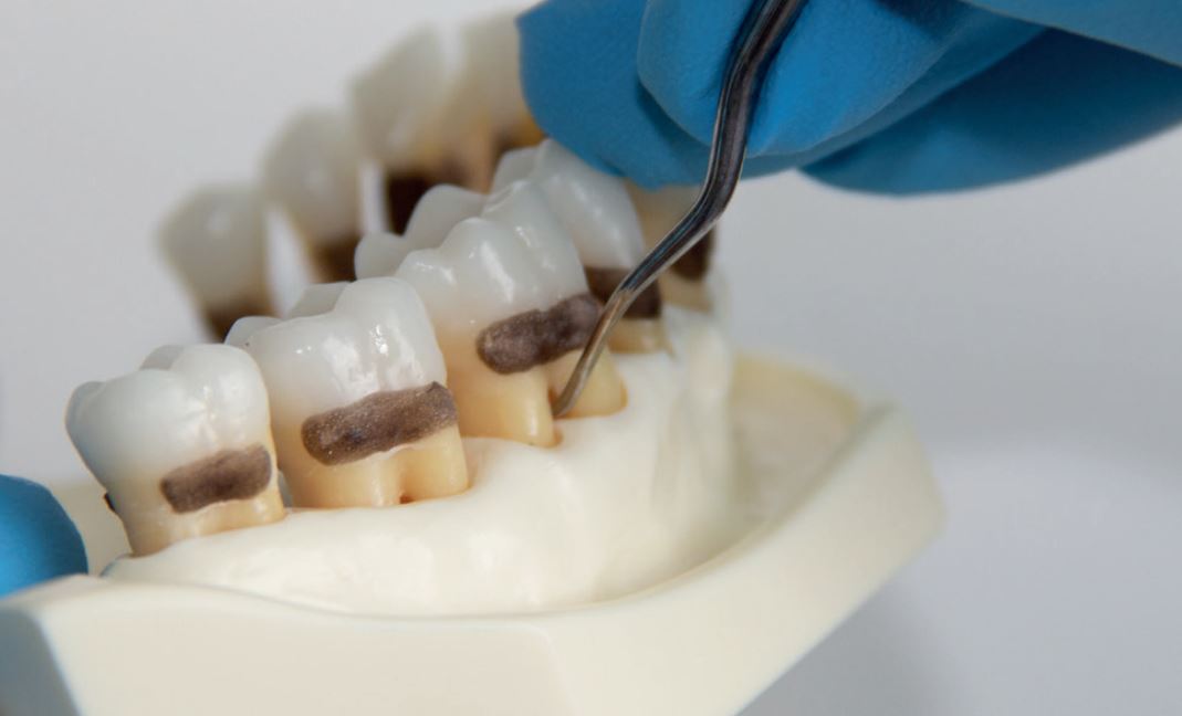 Langer Figure Effective instrumentation with LM™ Langer curettes - LM-Dental