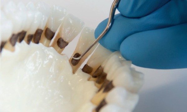 Langer Figure Effective instrumentation with LM™ Langer curettes - LM-Dental
